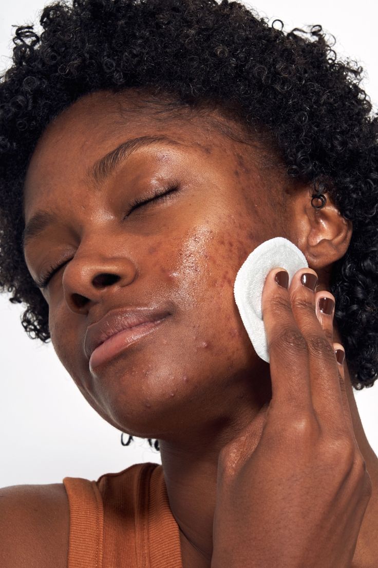 Bye Bye ACNE